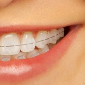 Tratamientos de ortodoncia para adultos